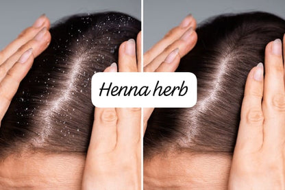 ANTI DANDRUFF KIT